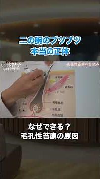 二の腕のぶつぶつの正体と原因#毛孔性苔癬#二の腕のぶつぶつ#皮膚科専門医