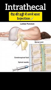 Varsha Singh on Instagram: "Intrathecal Injection: Spine ke through dawa ka direct impact!  Anaesthesia ya chemo ka powerful route — samjho simple steps mein! Medical & nursing students ke liye must-watch reel! #IntrathecalInjection #SpinalInjection #NursingReels #MedicalReels #AnatomyInHindi #HinglishLearning #SkillUpWithReels #NursingEducation #varshanursingacademy #mad360 #trending #nursing #gnm #reels"