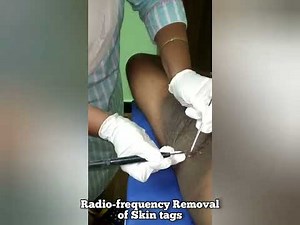 ACANTHOSIS NIGRICANS