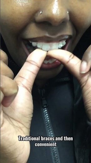 Straighten your teeth without traditional braces😲