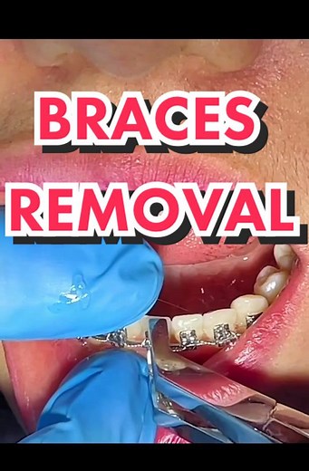 Braces Removal and Impression Taking for Retainers