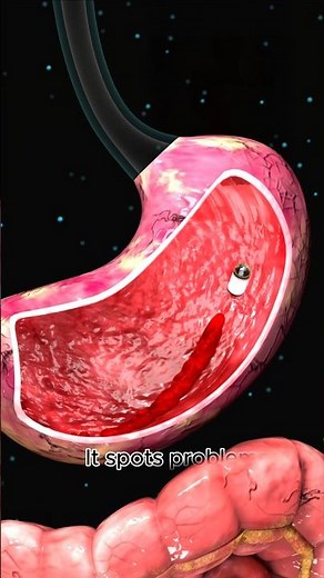 How Doctors Use Capsule Endoscopy