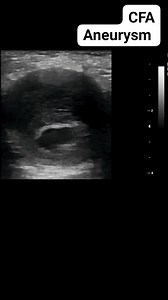Common femoral artery aneurysm on ultrasound #aneurysm #radiology #medical #radiologist #fblifestyle #ultrasound | Radiology Interesting Cases