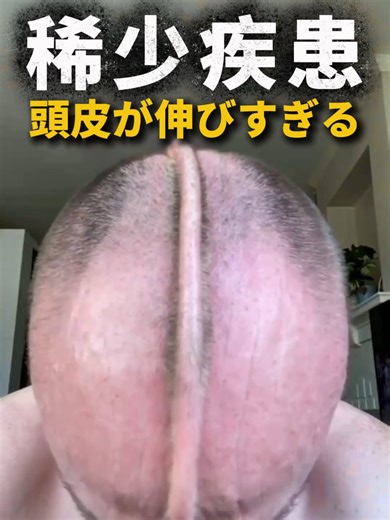 人間の皮膚の伸縮性の限界