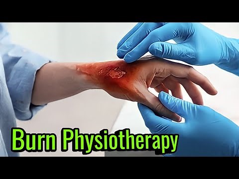 Physical Therapy for burn patients - Assessment and Management | Burn Physiotherapy Rehabilitation