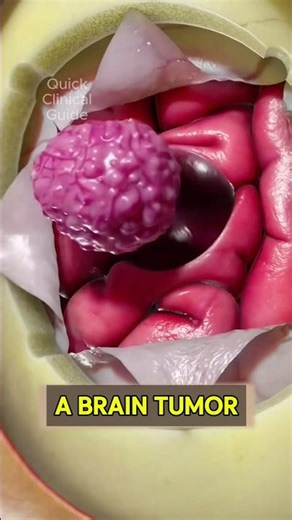 Craniotomy Brain Tumor Surgery 3D Animated #braintumor #craniotomy #surgery