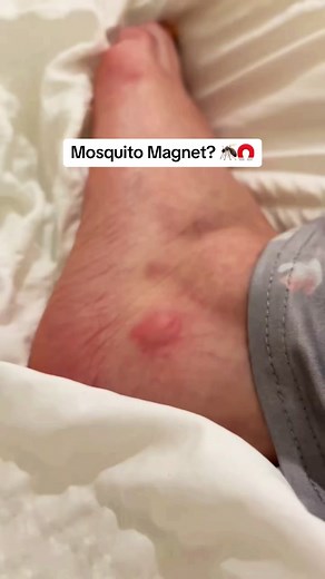 Bug Bite Thing on TikTok