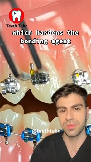 Putting Braces On - Step By Step