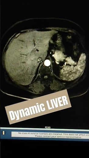 Dynamic Liver Scan MRI