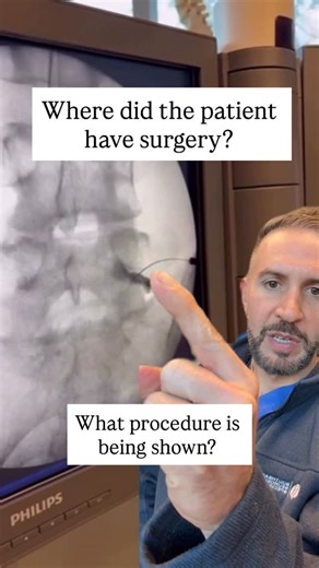 𝗗𝗿. 𝐒𝐭𝐞𝐯𝐞𝐧 𝐒𝐩𝐢𝐭𝐳 | 𝐍𝐞𝐮𝐫𝐨𝐬𝐮𝐫𝐠𝐞𝐨𝐧 on Instagram: "🧠 Not all spine surgeries are the same — especially when it comes to decompressing one level. Here’s the breakdown ⬇️ 🔹 Laminotomy — “otomy” means to make an opening. A small window is created in the lamina (the bone covering your spinal