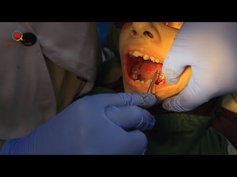 How Surgical Tooth Extraction Really Happens #toothoperation #teethremovaloperation #teethextraction