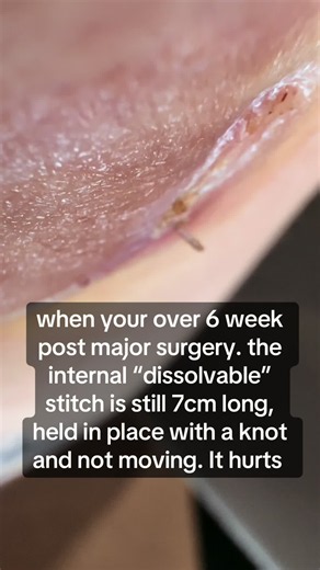 THIS is not INFECTED!! just because you see something draining from a wound does not mean infection, and kindly if you’re not my doctor, shush. I have been reviewed by the appropriate medical professionals. And if that is not you, you don’t get to comment. before anyone is like don’t squish it….. sush. you’re not the one with a very solid supposedly dissolvable 7 cm long stitch literally stuck underneath your skin!!! my wound and incision is 7 cm long, the stitch runs along the inside so don’t t