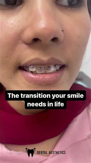 Braces On | Braces in Pakistan at Dental Aesthetics