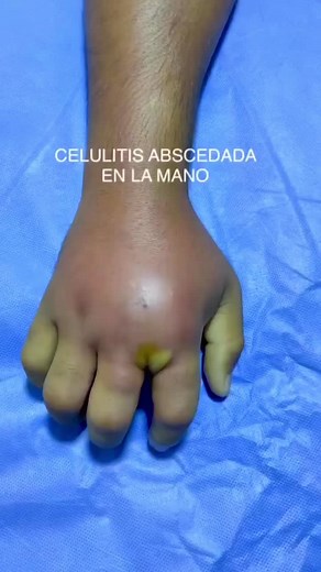 Celulitis Abscedada de la Mano: Signos, Síntomas y Tratamiento