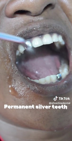 All About Permanent Silver Teeth: Procedure, Types, and More
