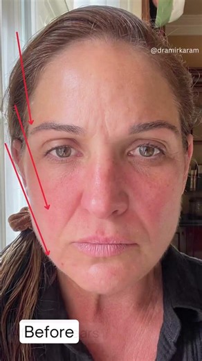 (No Makeup) 2 Year Update - Natural Facelift Result Looks Better Than Ever