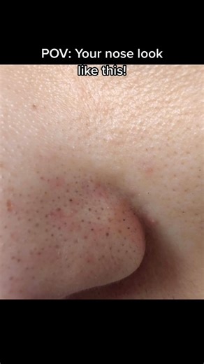 Does your nose look like this! #blackheads #sebaceousfilament #cloggedpores | Dr. Farzan