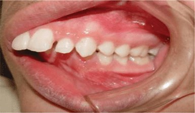 Maloclusión de Clase 2: qué es y cuál es su tratamiento en niños y adultos