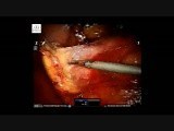 Robotic excision of a large retroperitoneal schwannoma • Video • MEDtube.net