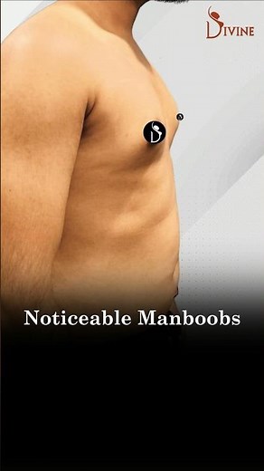 Redefine Your Chest in Minutes – Divine’s 360° Gynecomastia Fix | Male Breast Removal