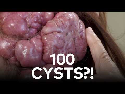She's Been Living With Nearly 100 Cysts | Dr. Pimple Popper S4 E20 | TLC India