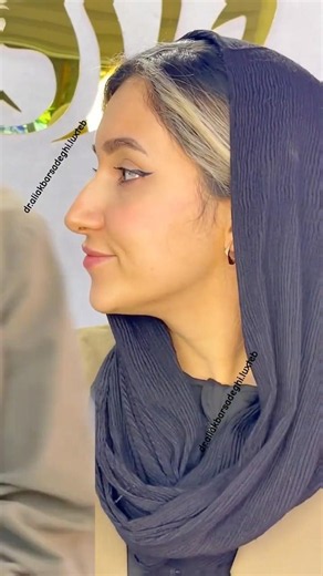 قبل وبعد عملية تجميل الأنف مع د. صادقي | نتائج طبيعية وتغيير واضح ✨