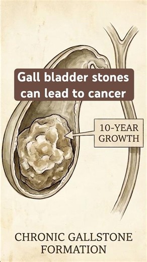 Gall stones can lead to cancer ?