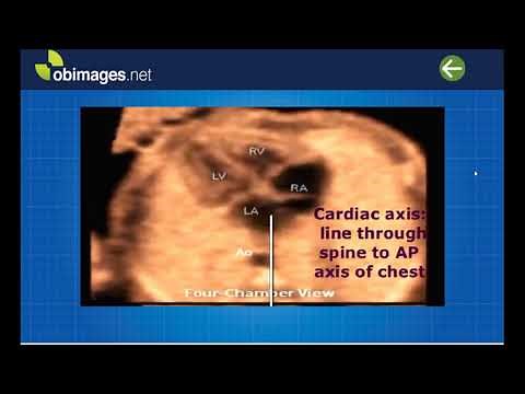 Normal fetal cardiac exam