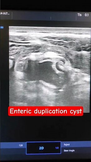 Enteric duplication cyst: key is gut signature of wall and noncommunication wiith GI tract.