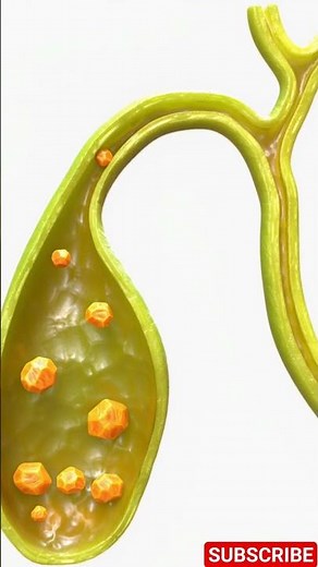 Inside the Human Body: 3D Gallstones Visualization