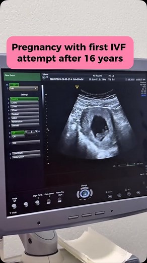 IVF Success Stories 🌟👶👶 Every fertility journey is unique, and for some, it takes years of hope, patience, and determination. Today, we share two incredible stories: ✨ 14 years later… a successful twin pregnancy 💙💖 ✨ 16 years later… a first-attempt IVF success 👶 These precious moments remind us why we do what we do—turning dreams into reality for families who never gave up. At BMP Fertility Clinic in Baku, we offer: ✔ Comprehensive pre-treatment in the UK 🇬🇧 ✔ Expert IVF care with advanc