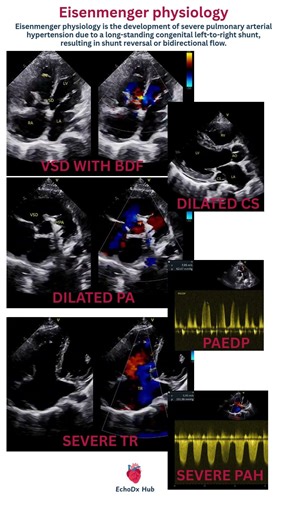 Eisenmenger physiology.