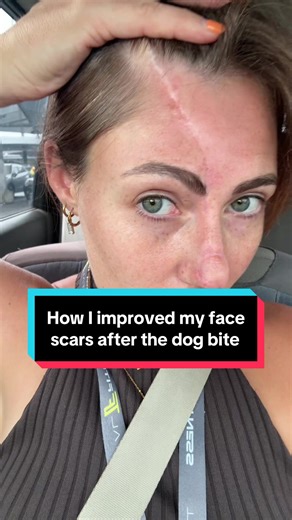 Things I did to reduce my face scars ❤️‍🩹 - Vaseline and deep massage (surgeon recommended!) he told me not to waste my money on bio oil as Vaseline works in the same way - red light therapy (game changer) @currentbody Ive collaborated with them as their masks are so amazing! CBSTEFF for discount - silicone scar sheets. Honestly couldn’t believe how well these worked, made me feel much more confident after sleeping with them over my nose as it did really fade and flatten my nose - tamanu balm, 
