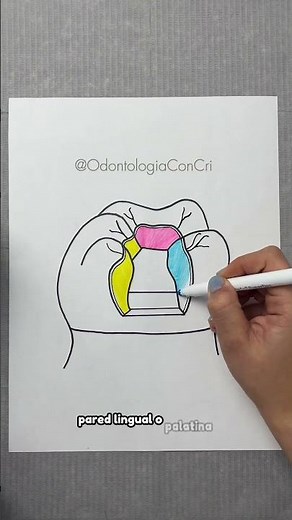 Walls of a Class II Dental Cavity | Dentistry With Cri