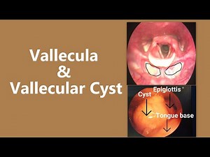 Vallecula & Vallecular Cyst: Understanding the Endoscopic View, Clinical Features & Treatment