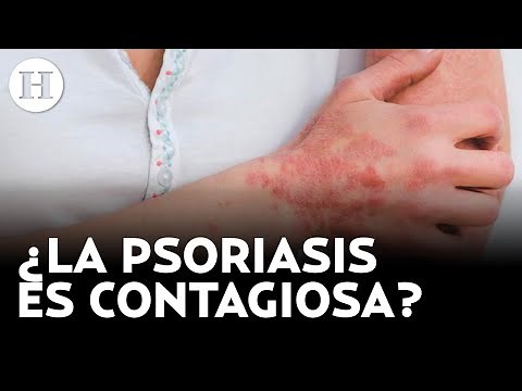 Psoriasis, una enfermedad de la piel que no tiene cura; te decimos cómo tratarla | Médico H