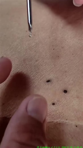 Satisfying Blackhead Removal Video