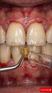 Deep Gum Cleaning ASMR – Fix Red & Swollen Gums Fast#asmrcleaning #GumCleaning#plaqueremoval