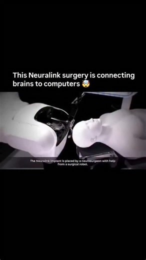 AI Emerges on Instagram: "Neuralink’s first human brain implants are happening now, and they blend robotics, AI, and neuroscience to create a direct link between the human brain and machines. A specialized surgical robot inserts ultra-thin electrode threads (thinner than a human hair) into the brain’s motor cortex, allowing computers to read neural signals that can control devices by thought alone. The implant has 1,024 electrodes across 64 flexible threads, and once placed under the skull, it’s