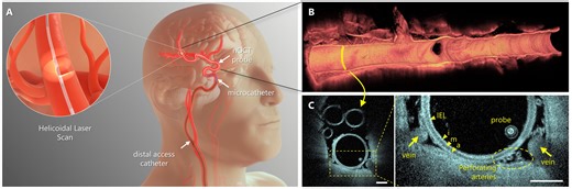 Miniaturized optical coherence tomography imaging probe takes pictures inside cerebral arteries