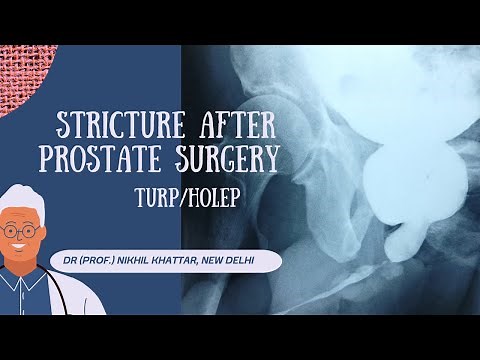 Urethroplasty for Post TURP / Post Holep Strictures of uretrhra