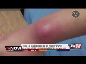 Hair-tie causes infection on woman’s wrist