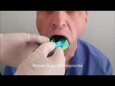 Prise d'empreinte dentaire alginate