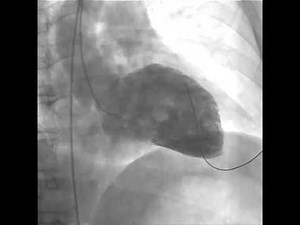 Ventricular Fibrillation during Left Ventriculography.