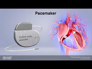 Pacemaker | What Is a Pacemaker and How Does It Help Your Heart? | Swasth Hriday