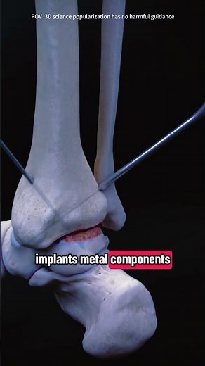 Total Ankle Replacement Surgery (3D Animation)#anklereplacement #anklesurgery #anklejoint