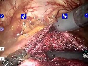 Robot assisted simple prostatetcomy (RASP), performed by Deliu-Victor Matei in Milan