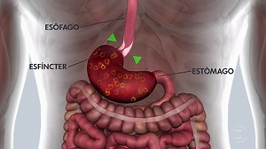 Médico tira dúvidas sobre azia e como evitar