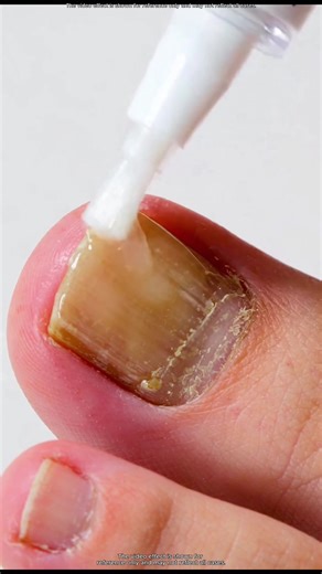 If you also encounter this situation, you can try this! #nailfungustreatment #healthynails #fungalnails #toecare #fingernailfungus