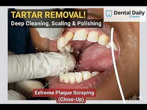 Tartar Removal! Deep Cleaning, Scaling & Polishing | Plaque Scraping (Close-Up) - New Video